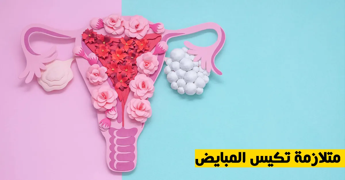 متلازمة تكيس المبايض